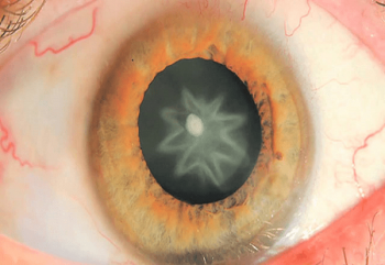 Quáng gà - Hình ảnh minh họa